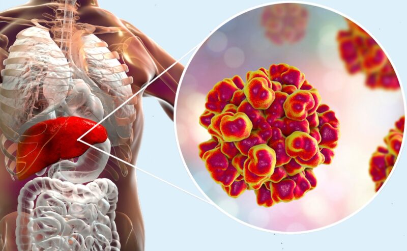 A Napoli si registra un aumento significativo dei casi di epatite A, con oltre 40 ricoveri al Cotugno e un trend in crescita anche nell’area metropolitana.