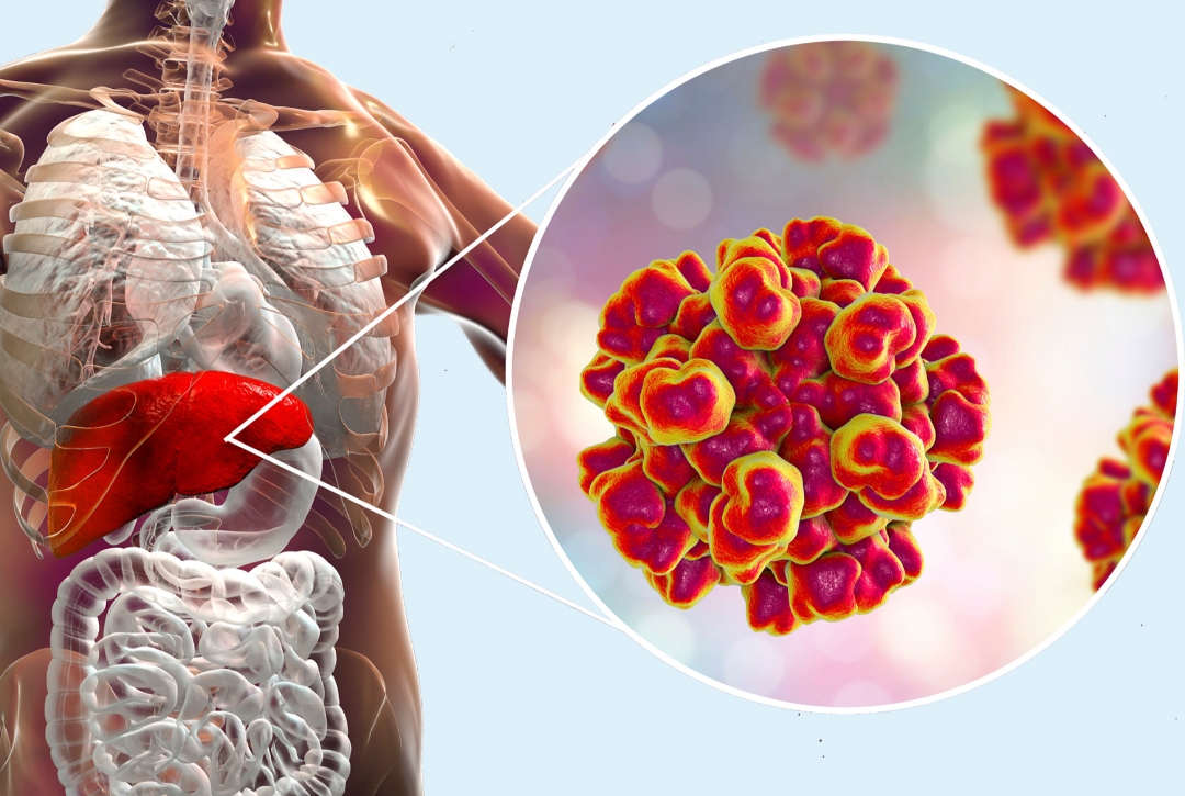 A Napoli si registra un aumento significativo dei casi di epatite A, con oltre 40 ricoveri al Cotugno e un trend in crescita anche nell’area metropolitana.